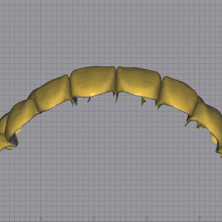 Dental Digital Mutilunit Veneer Design factory