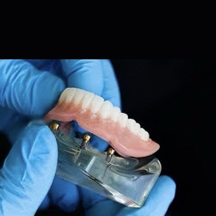 Dental Implant Supported Denture suppliers