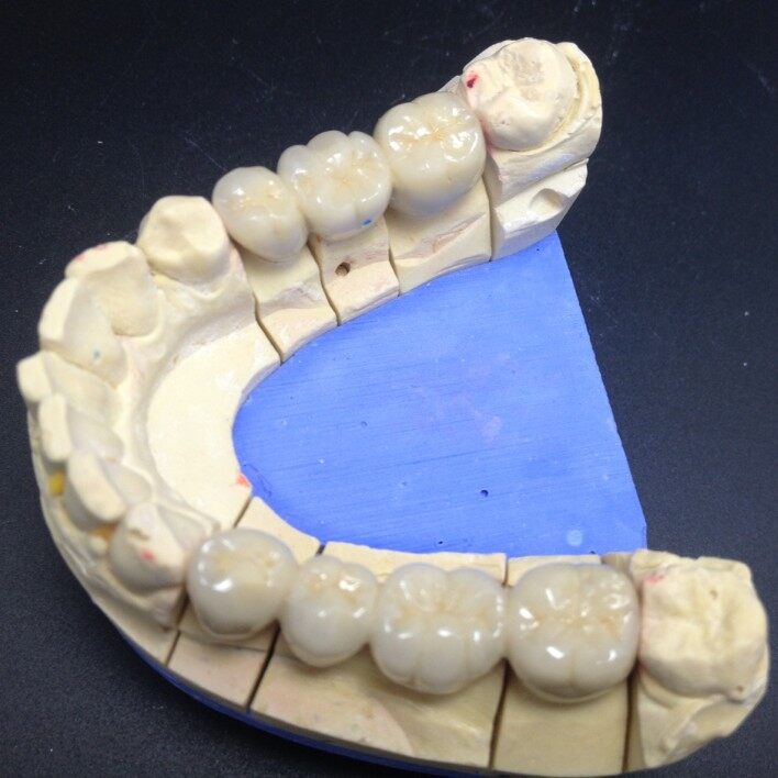 Dental Porcelain Fused To Metal CoCr Crown suppliers