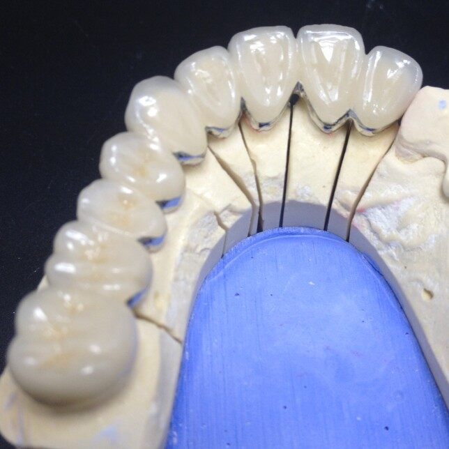 Dental Porcelain Fused To Metal CoCr Crown factory