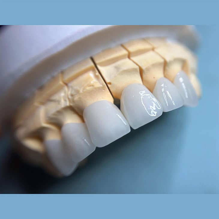 Dental Porcelain Layered Zirconia Crown high quality