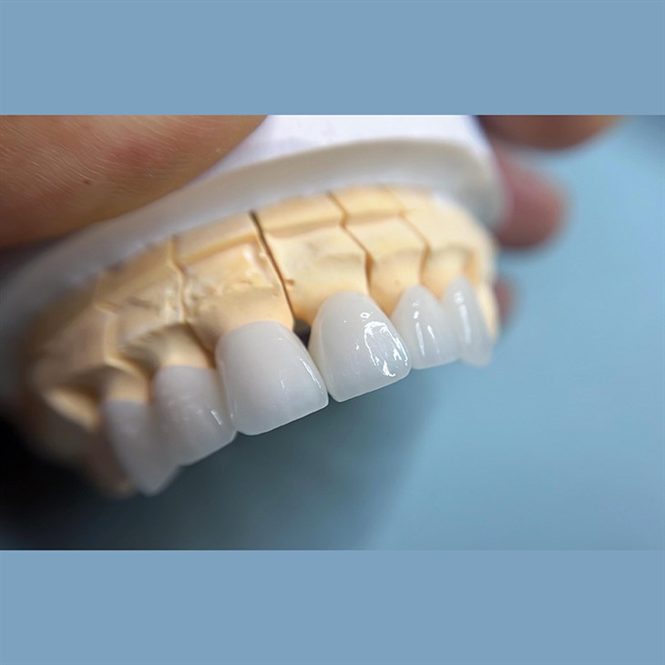 Dental Porcelain Layered Zirconia Crown suppliers