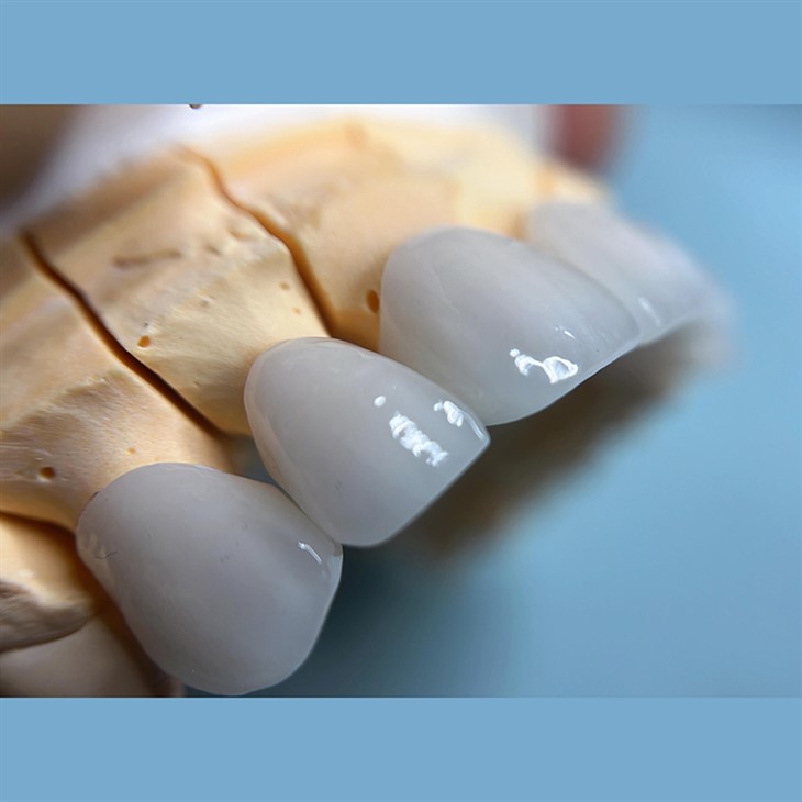 Dental Porcelain Layered Zirconia Crown best
