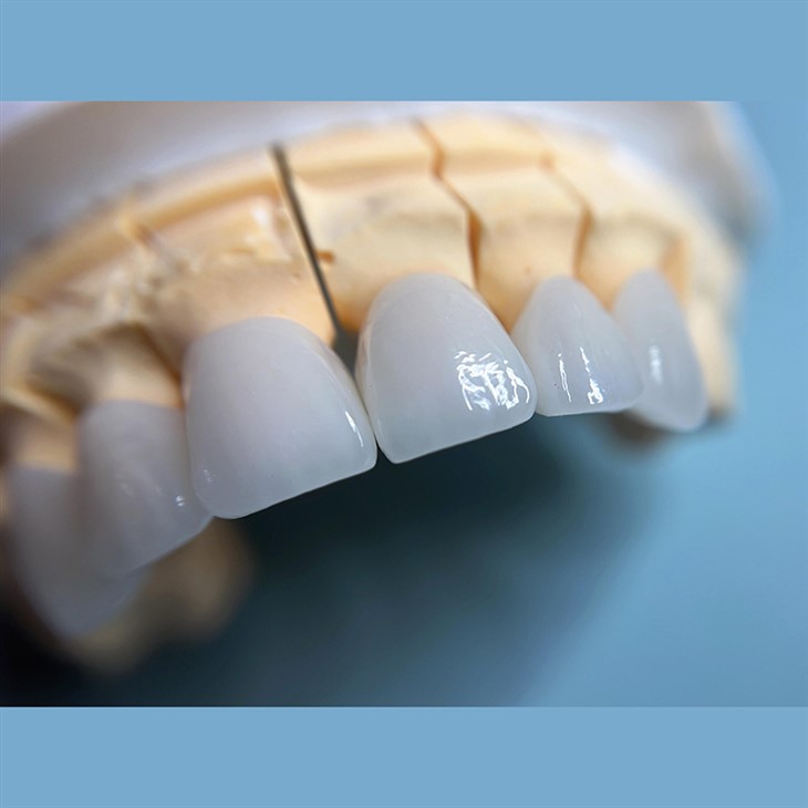 Dental Porcelain Layered Zirconia Crown price