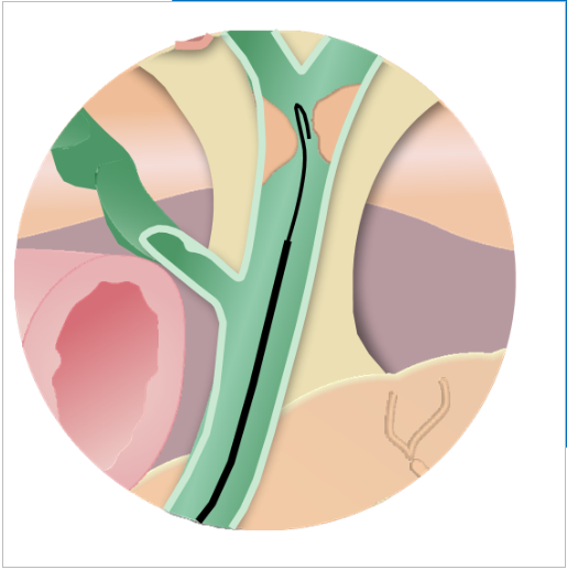 PTFE Zebra Guide Wire J Tip 150cm Length high quality