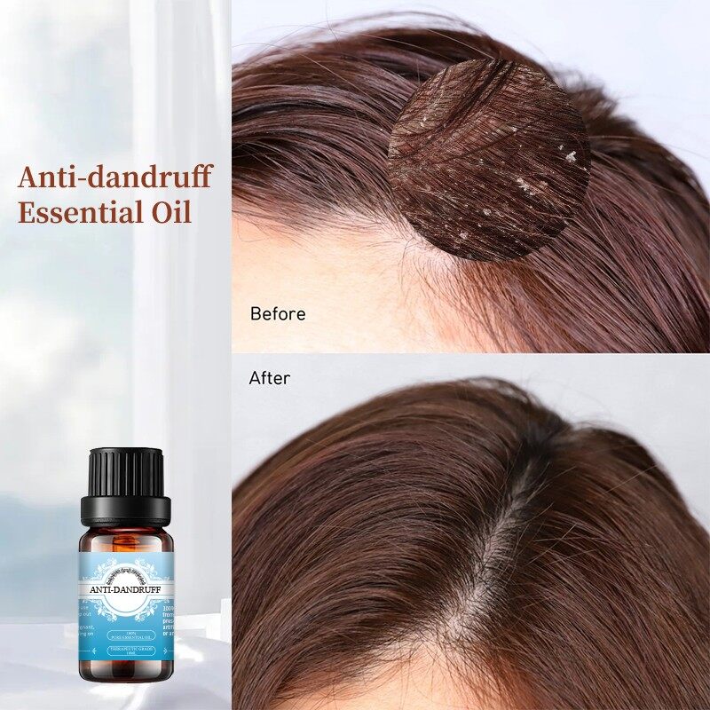 ANTI-DANDRUFF