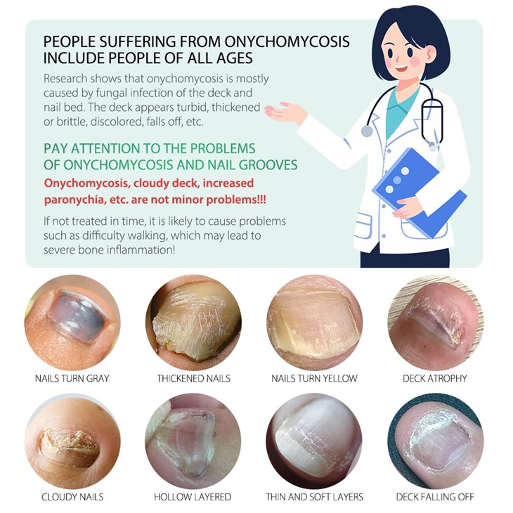 7 Days Nail Fungus Treatment Serum