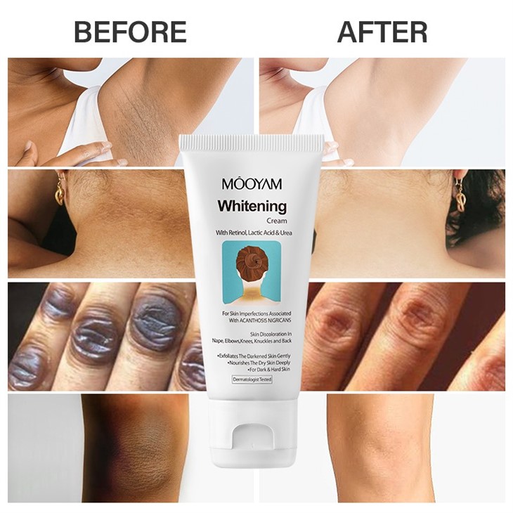 Acanthosis Nigricans Therapy Cream