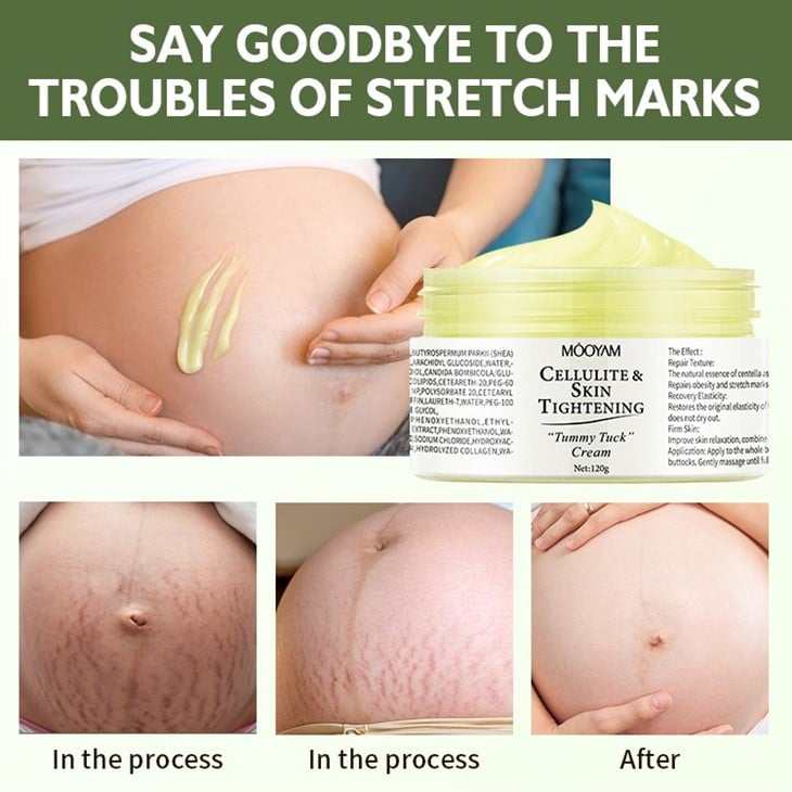 Celluilte & Skin Tightening Stretch Mark Cream