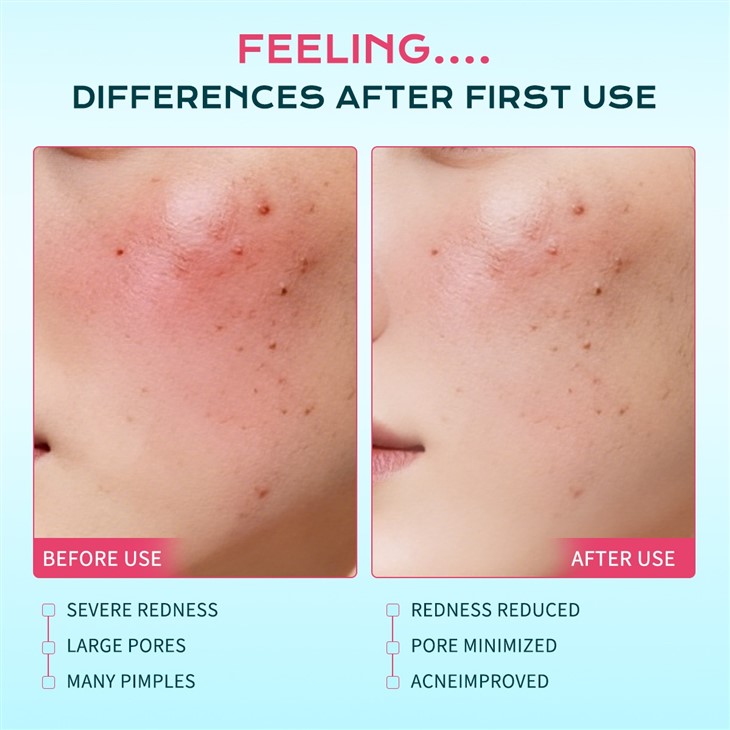 IREV Salicylic Acid Refreshing Acne-Clearing Pads factory