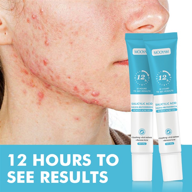 حمض mooyam salicylic يزيل هلام حب الشباب