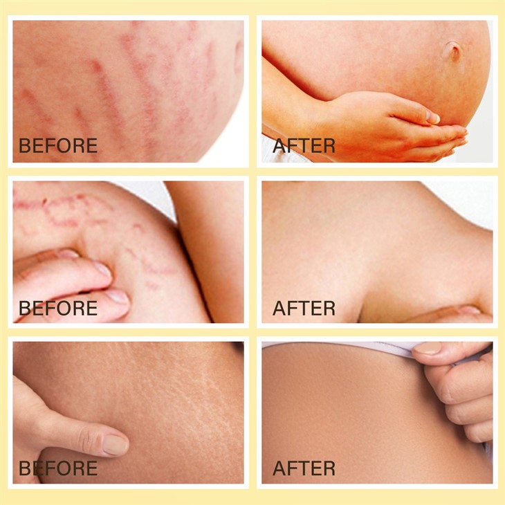 Stretch Mark Removal Oil