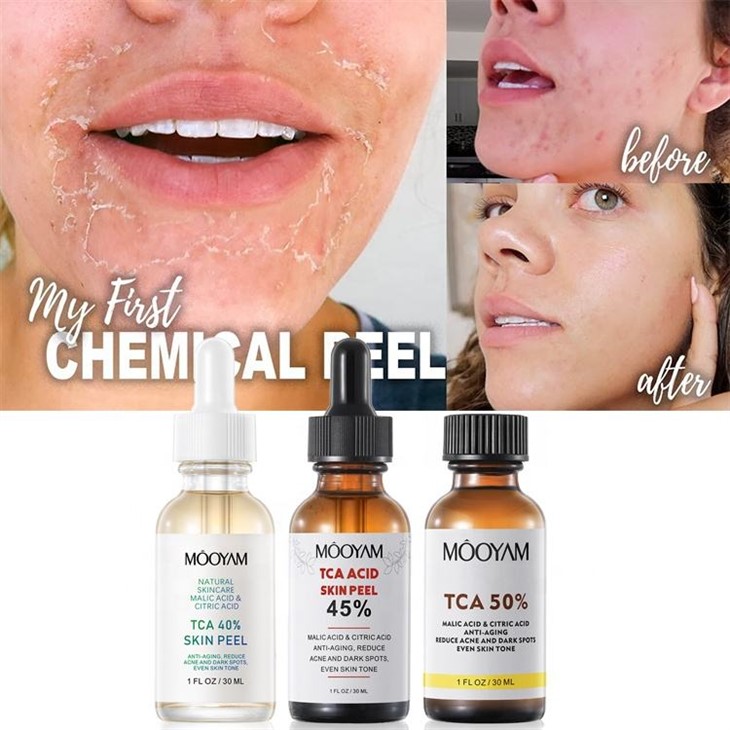 TCA Skin Peel Serum