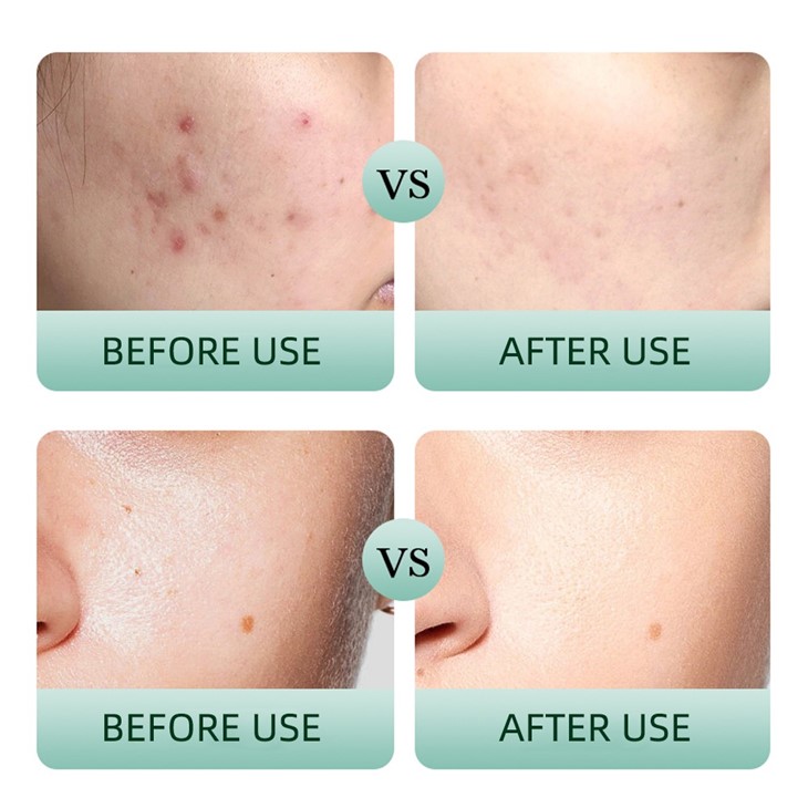 Tea Tree Salicylic 30days Anti-Acne Skincare Set