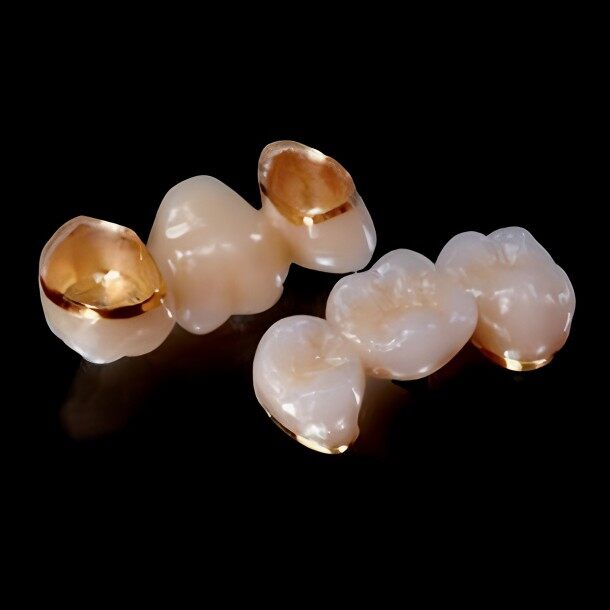 Dental Porcelain Fused To High Noble Metal Crown