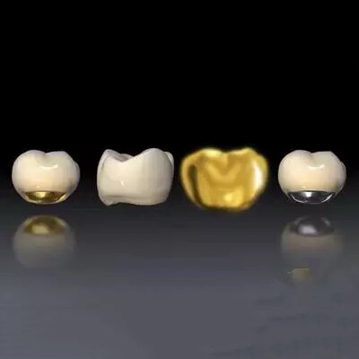 Kev Kho Hniav Fused rau Semi precious crown