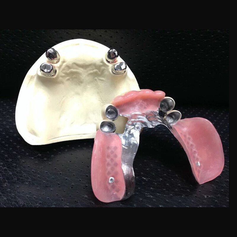 Attacco di precisione del telescopio dentale con protesi