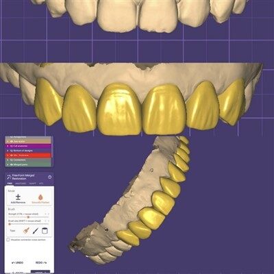 Dental Digital Crown och Bridge Design