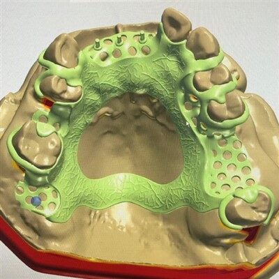 歯科用デジタルメタルフレーム設計