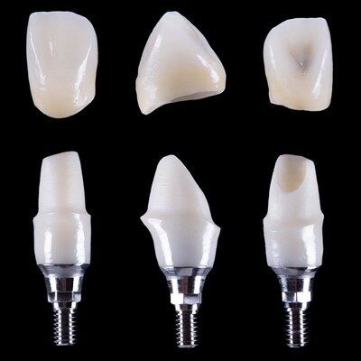 Dentalant abutment