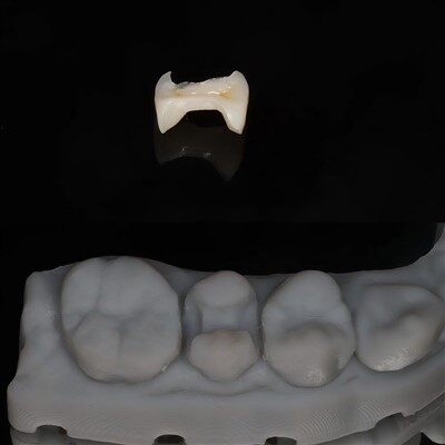 Naturaleza dental RESTORTORIA EMAX ONLA