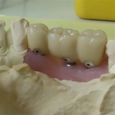 Tannlækningar PFM skrúfandi ígræðslukóróna