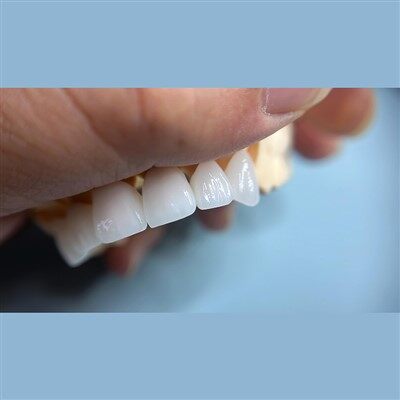 Trang phục Zirconia Lớp sứ