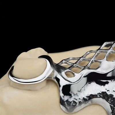 Tannt títan málm ramma