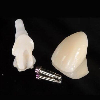 Стоматологічний цирконічний цемент зберігається коронкою імплантатів