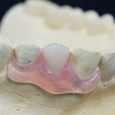 Aftari molar einhliða dalplast