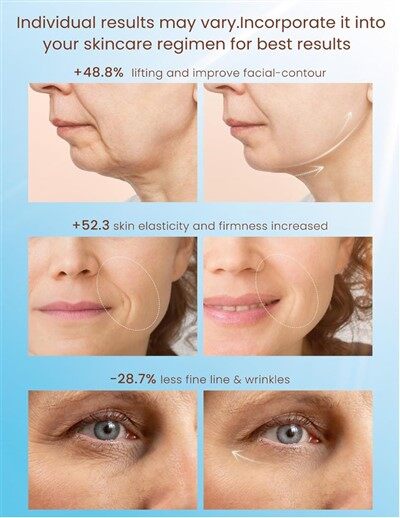 Visoko{0}}ultra{1}}pulzna lepotilna naprava